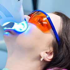 Teeth Whitening: the Facts about Bleaching Teeth
