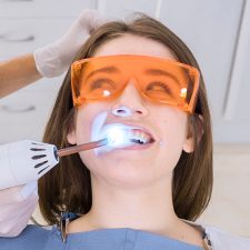 Benefits of Dental Bonding Treatment