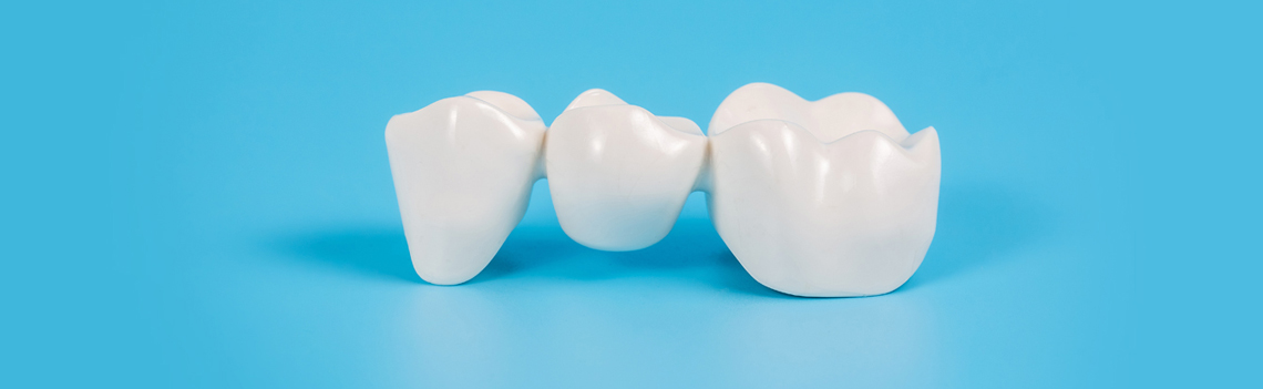 The Lifespan of Dental Bridges for Molars: How to Care for Them