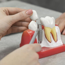 A New Beginning: Embracing Confidence with Dental Implants