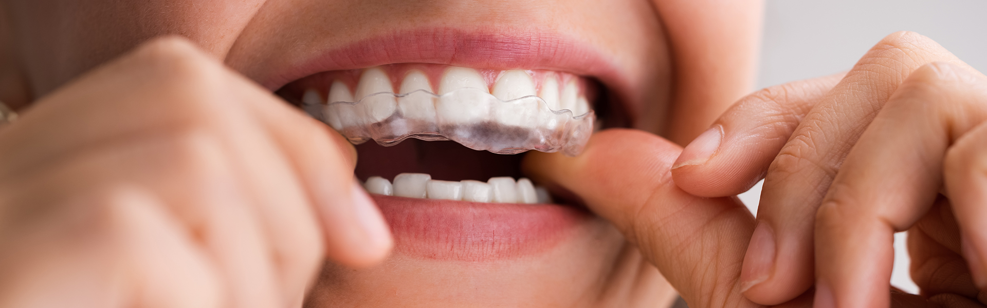 Transform Your Smile: The Ultimate Guide to Invisalign
