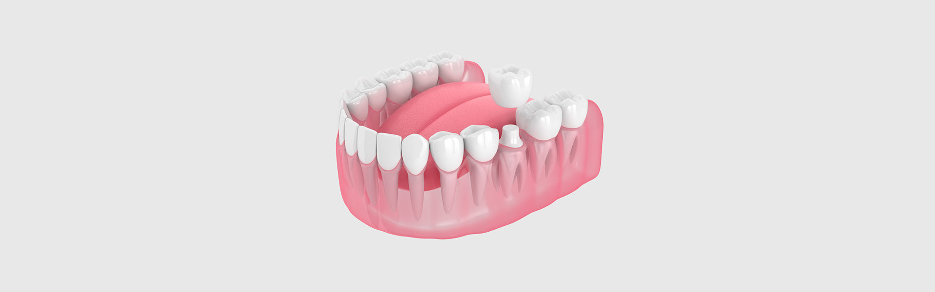 Protect and Perfect Your Smile with Dental Crowns