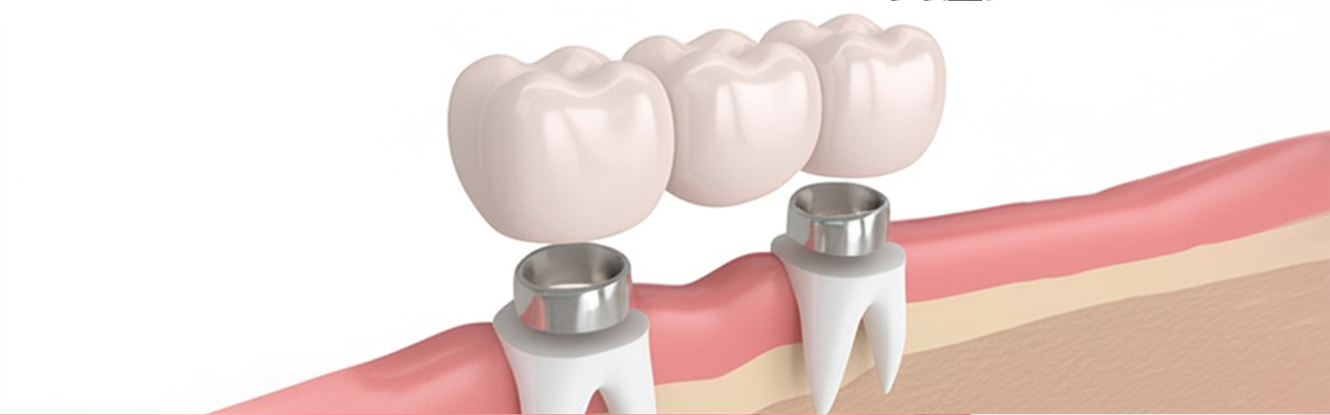 Crowns, Bridges, and Fillings: A Beginner’s Guide to Restorative Dentistry