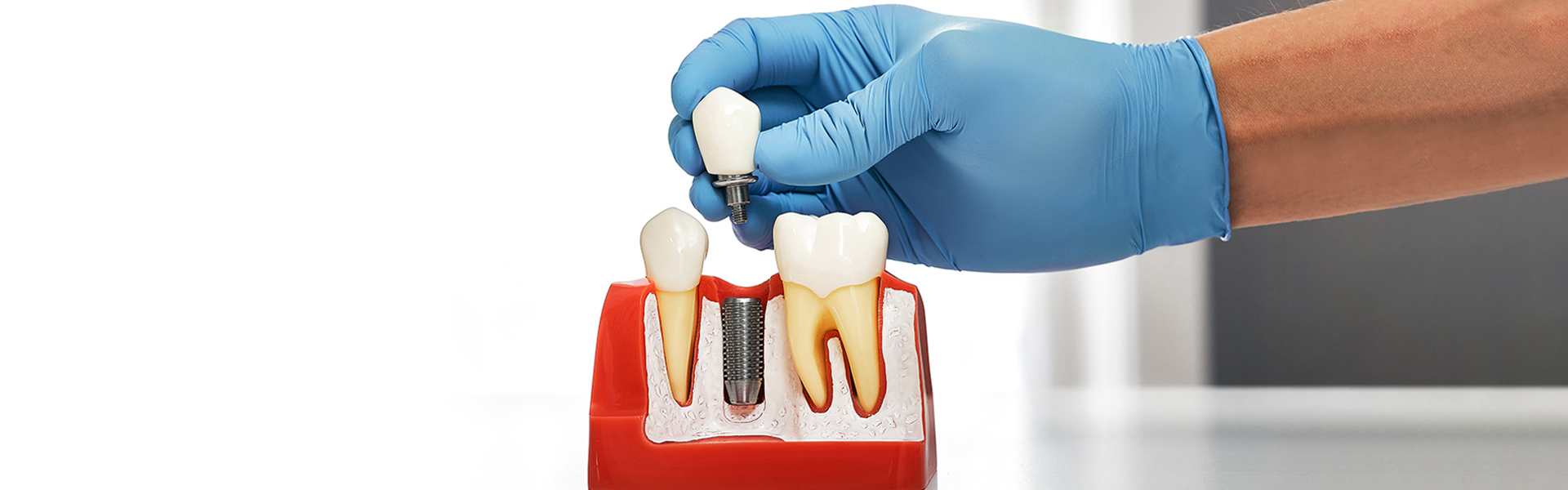 Why Implants Are Ideal for Tooth Loss