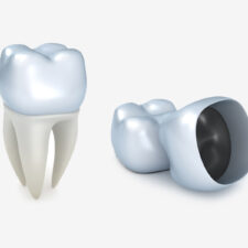 How to Care for Your Dental Crown After Treatment in Stockton, CA
