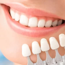 Common Problems with Veneers and How to Handle Them: Causes, Fixes, and Prevention