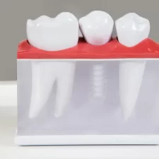 What You Should Know before Choosing the Right Dental Clinic for Dental Implants